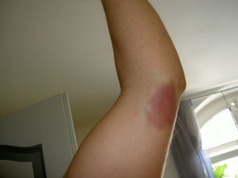 Ellbogen.jpg Ellbogen.jpg