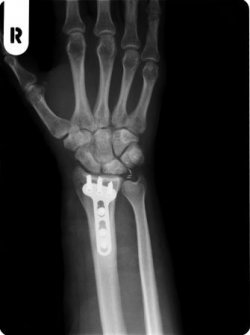 Hand OP5.jpg